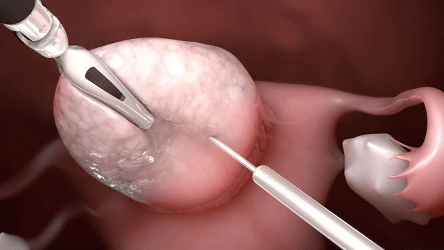Animación médica de una miomectomía laparoscópica